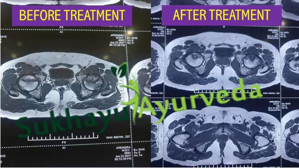 Avascular Necrosis Stage 2 and 3 treatment