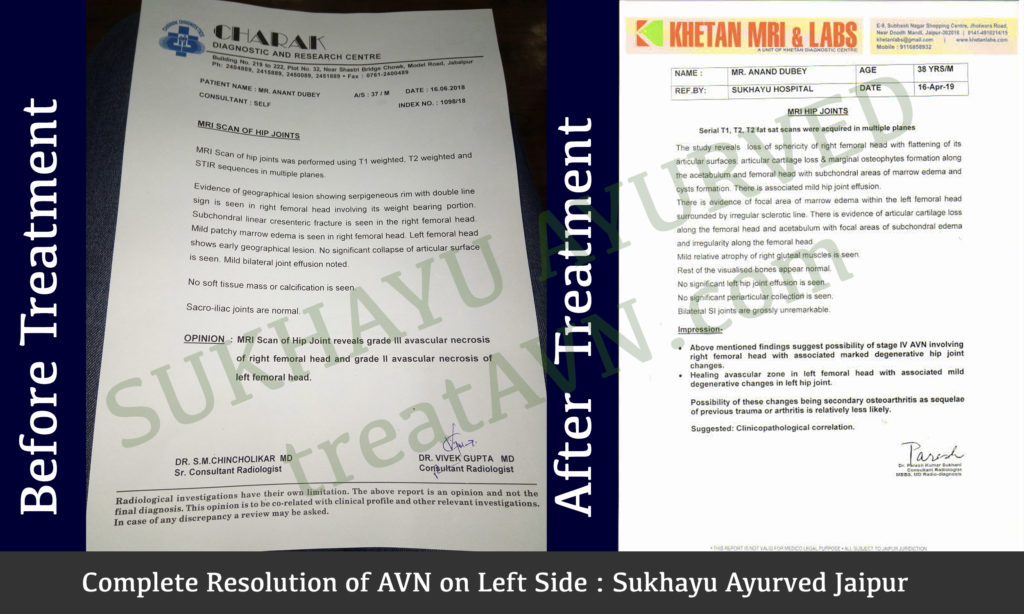 complete resolution of avn