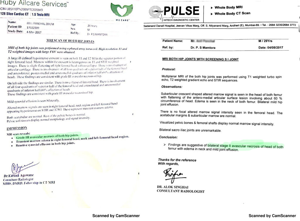 avascular necrosis without surgery