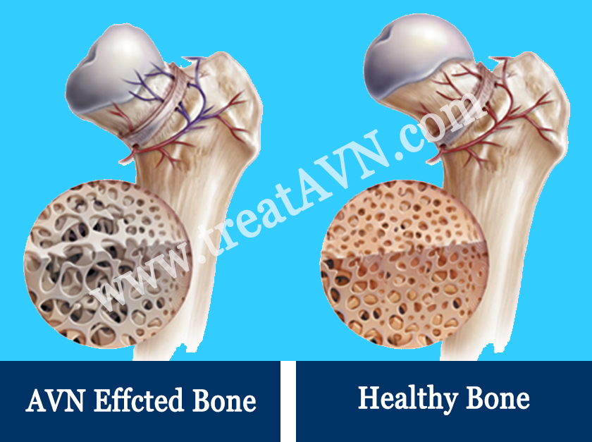 Avascular Necrosis