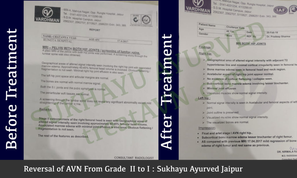 Treated Case of AVN: Reversal of Grade II to Grade I