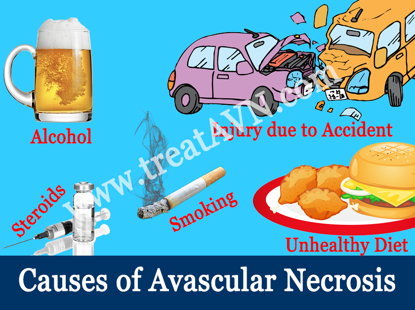 What causes AVN
