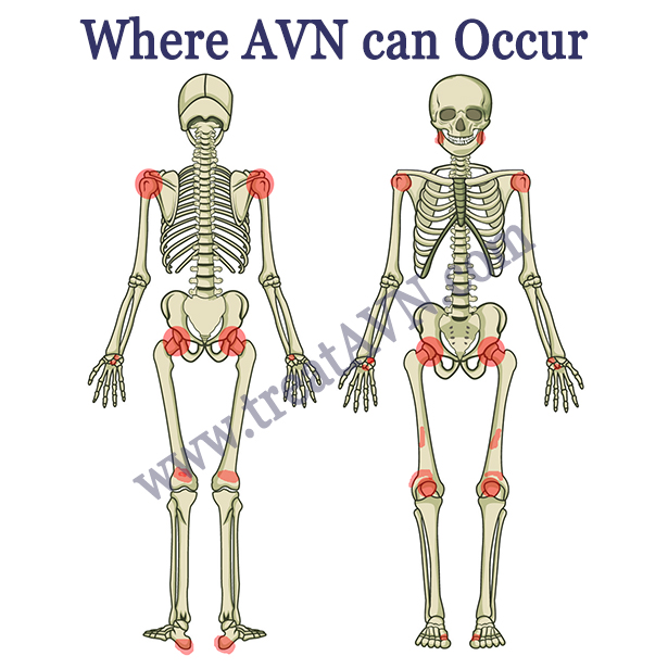 Where can you get AVN